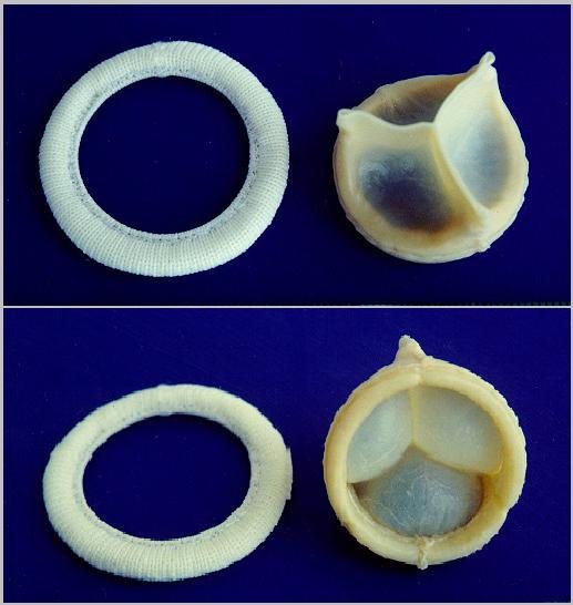 Prothèses valvulaires : choix mécanique vs bioprothèse