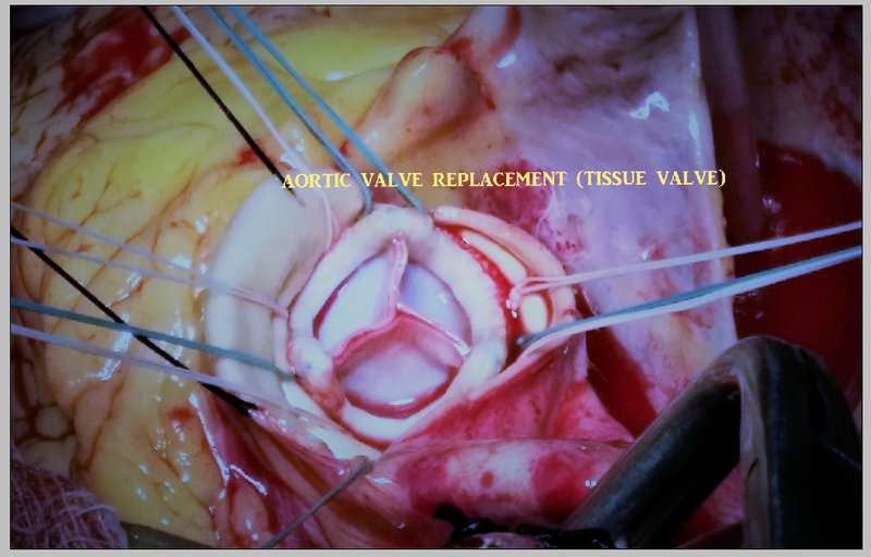 Prothèses valvulaires : choix mécanique vs bioprothèse