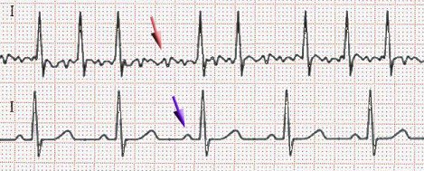 TAVI : bioprothèse percutanée