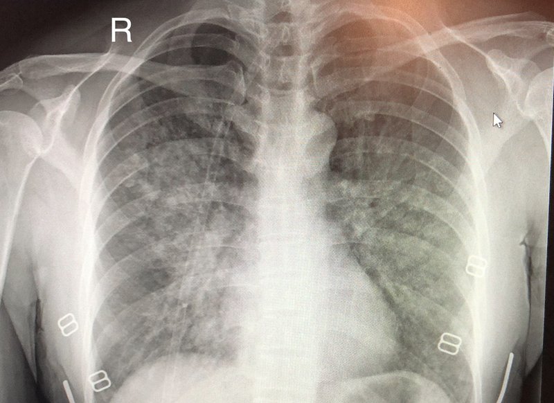 Thrombose de prothèse valvulaire