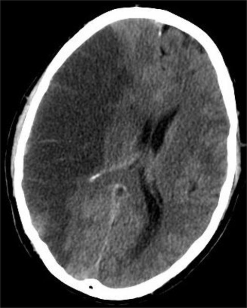 Thrombose de prothèse valvulaire