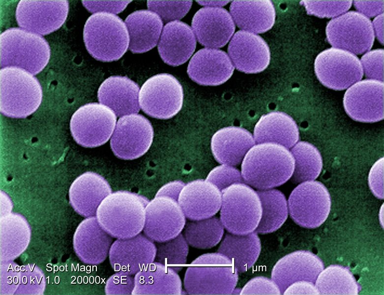 Endocardite infectieuse sur prothèse