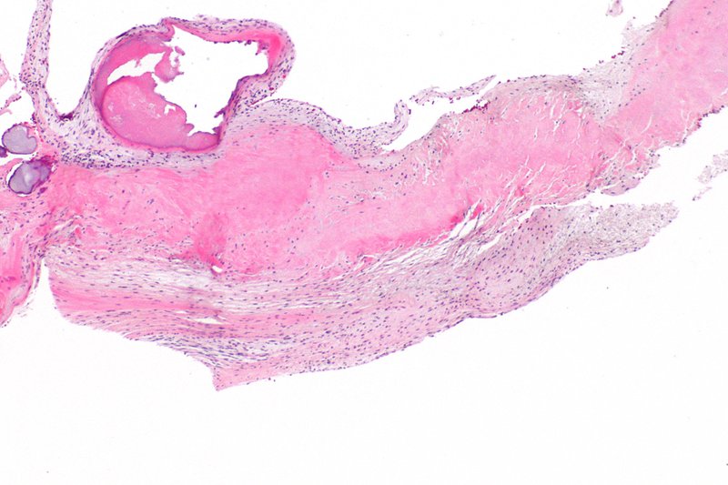 Endocardite infectieuse sur prothèse