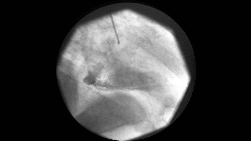 Gestion des AVK : chirurgie et grossesse