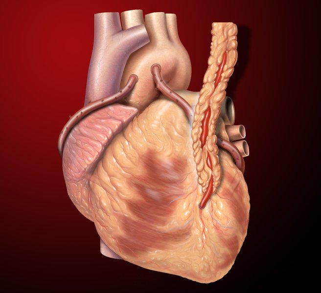 Prothèses vasculaires : types et complications