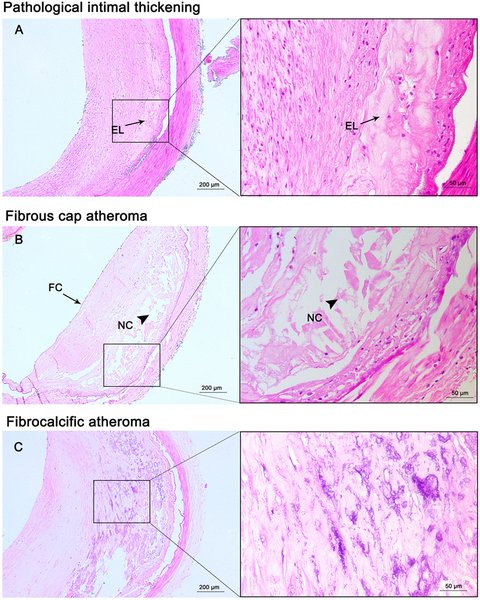 Athérogenèse : mécanismes et histologie de la plaque