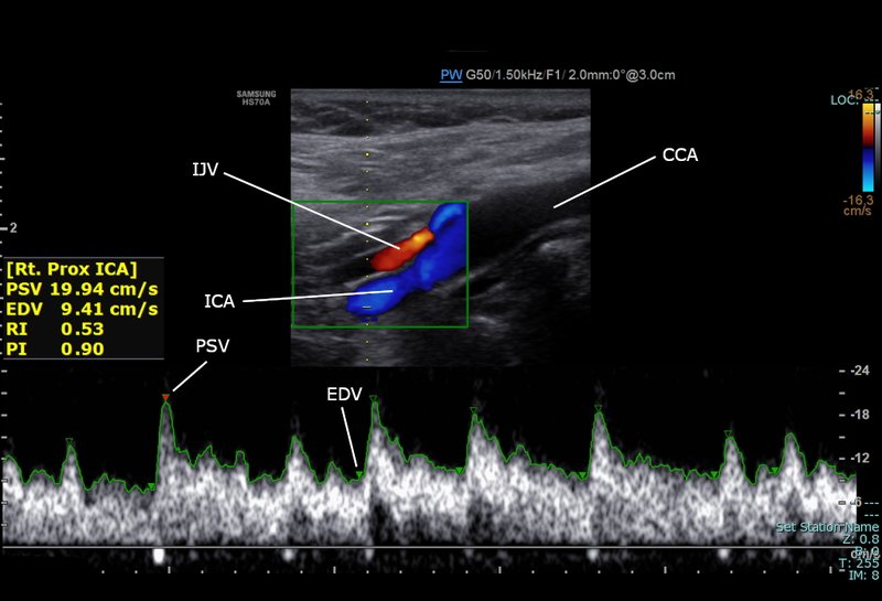 Patient polyathéromateux : bilan multi-territorial