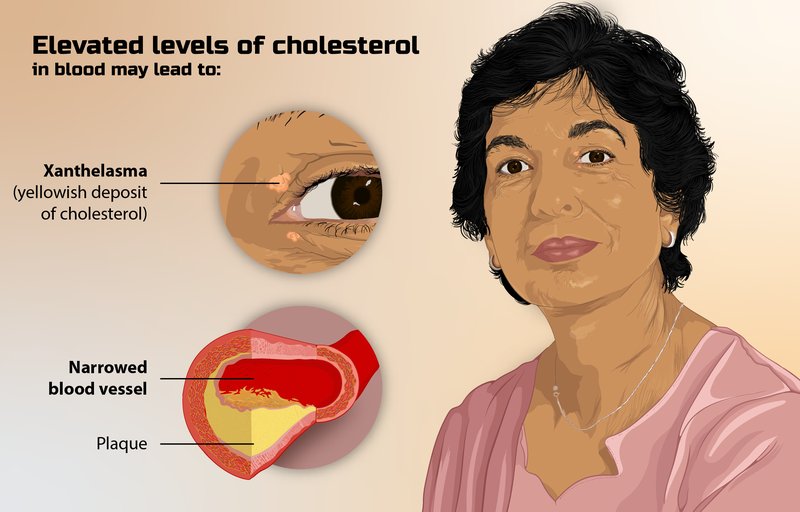 Hypercholestérolémie et LDL-cholestérol
