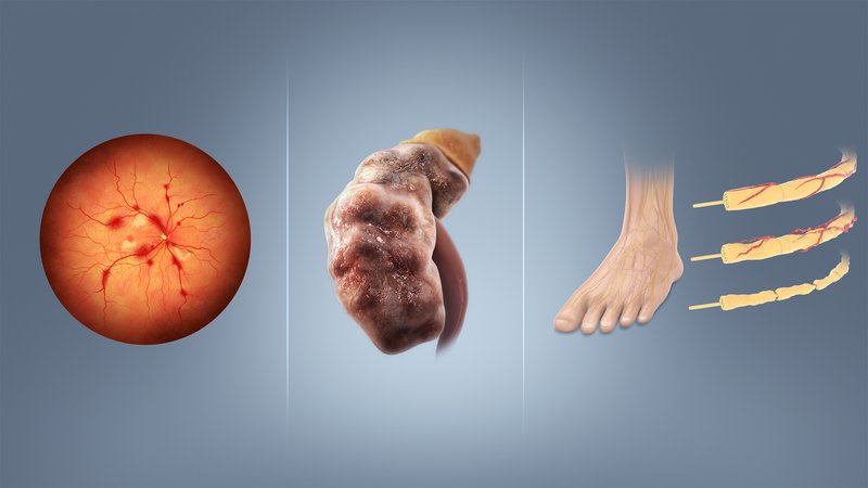 Diabète et risque cardiovasculaire