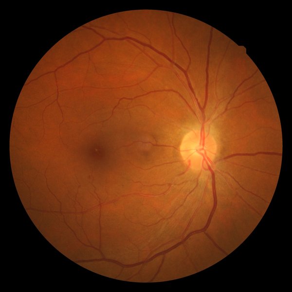 Rétinopathie hypertensive