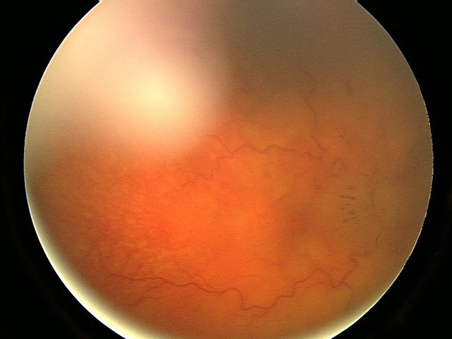 Rétinopathie hypertensive