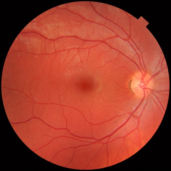 Rétinopathie hypertensive
