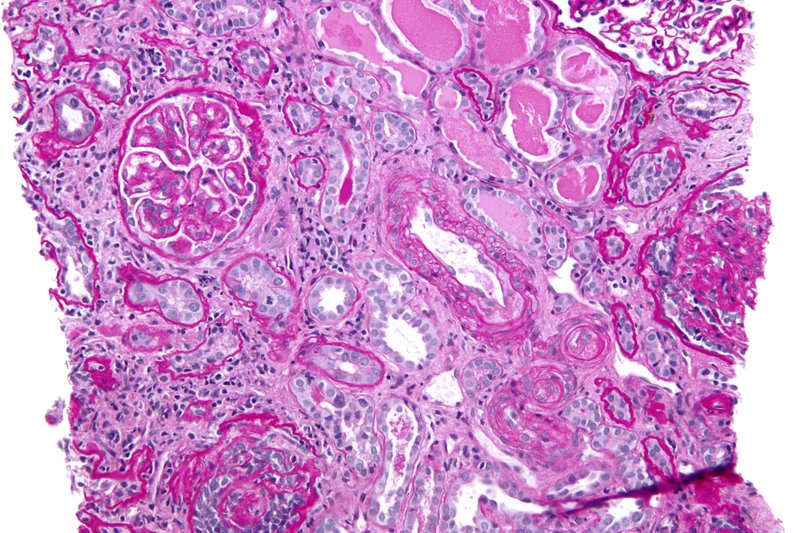 Crise aiguë hypertensive et HTA maligne