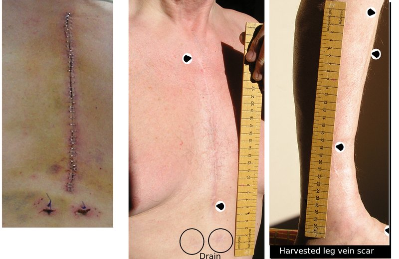 Revascularisation AOMI (angioplastie, pontage)