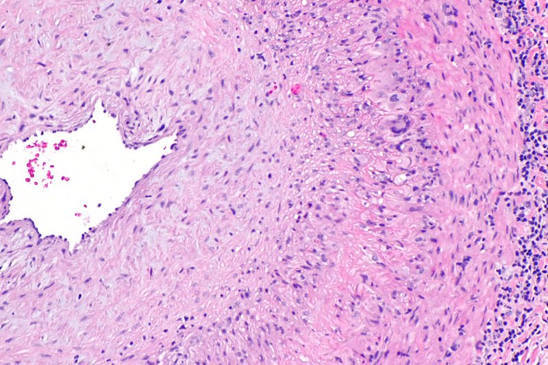 Artériopathies non athéromateuses