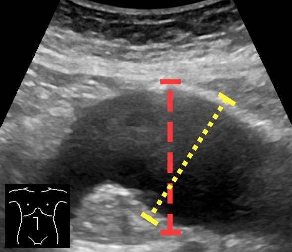 Anévrisme de l'aorte abdominale (AAA) : diagnostic