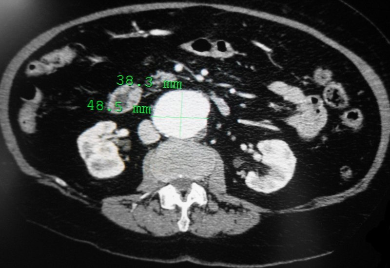 Anévrisme de l'aorte abdominale (AAA) : diagnostic