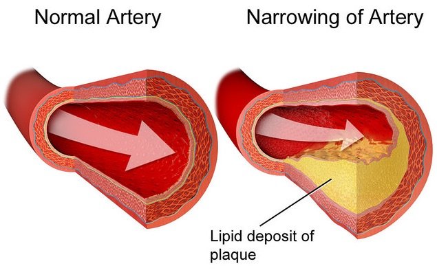 Anévrisme de l'aorte abdominale (AAA) : diagnostic
