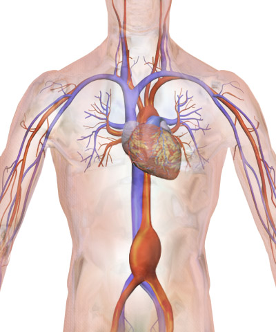 AAA : complications (rupture, embolie, compression)
