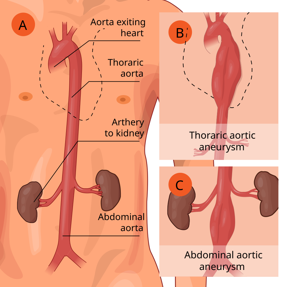 AAA : traitement (chirurgie, EVAR)