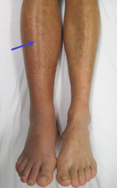 Syndromes de compression vasculaire