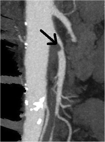 Syndromes de compression vasculaire