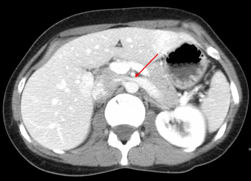 Syndromes de compression vasculaire