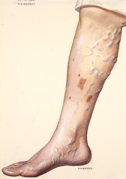 Physiopathologie du retour veineux et de l'IVC