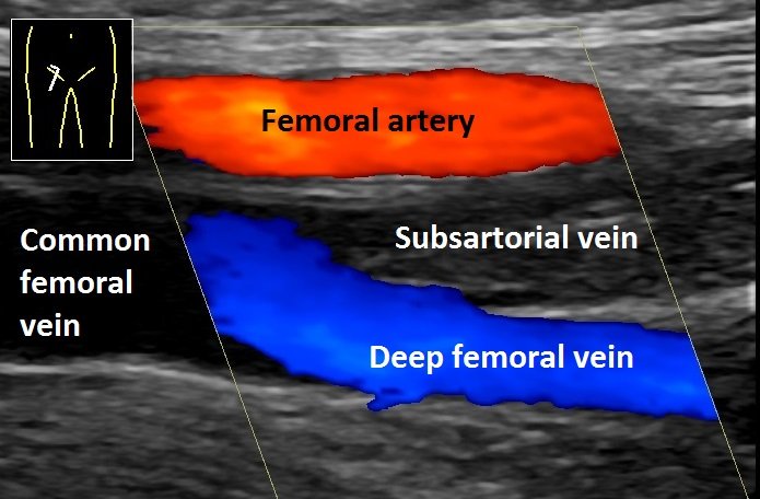 Étiologies de l'IVC