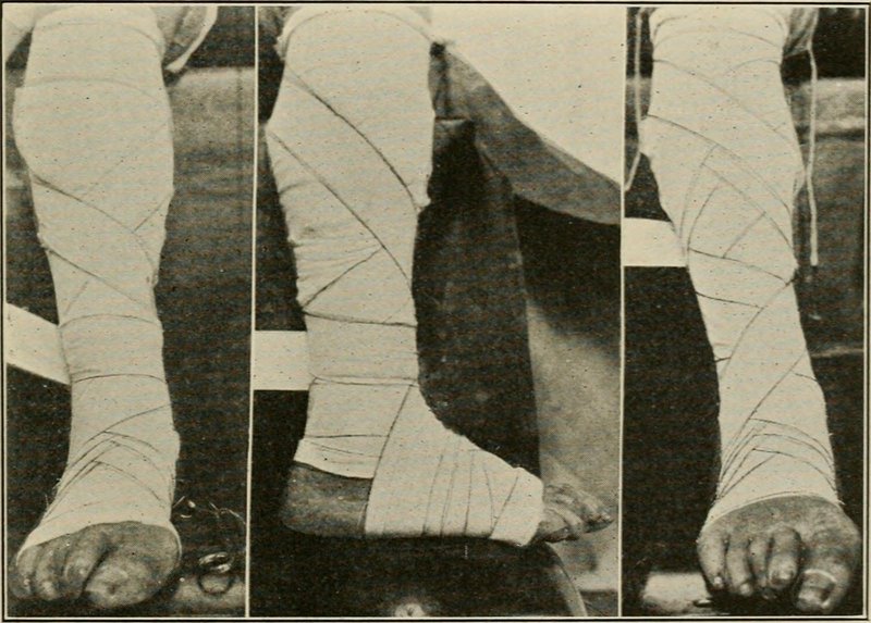 Complications de l'IVC (dermite ocre, ulcère veineux)