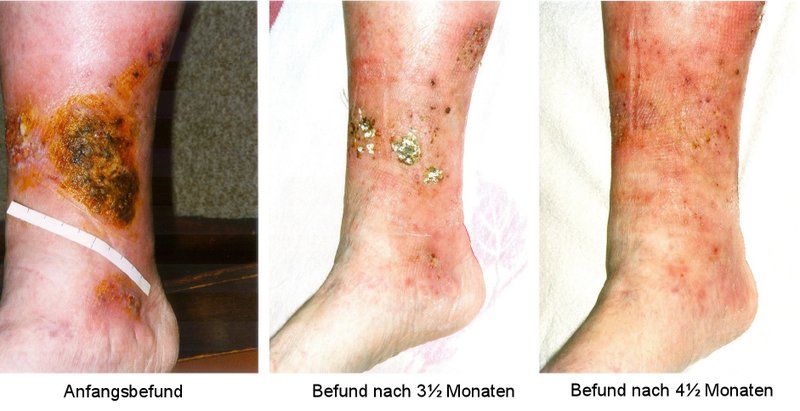Complications de l'IVC (dermite ocre, ulcère veineux)