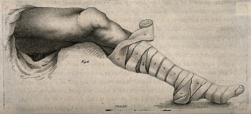 Traitement de l'IVC (compression, sclérothérapie, chirurgie)
