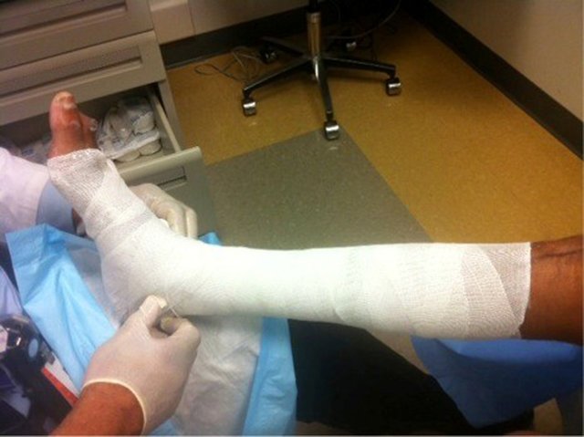 Traitement de l'IVC (compression, sclérothérapie, chirurgie)