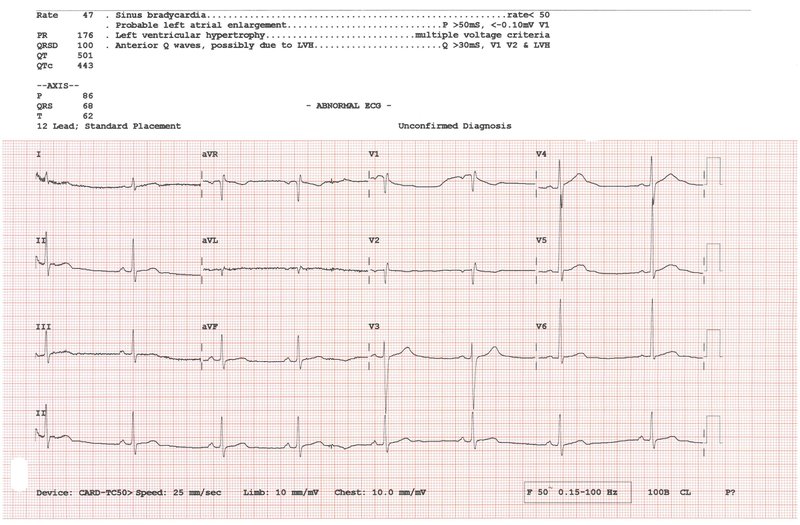 Orientation devant une douleur thoracique (urgences immédiates)