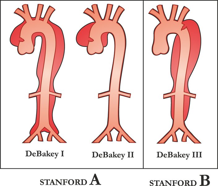 Dissection aortique : physiopathologie et classification