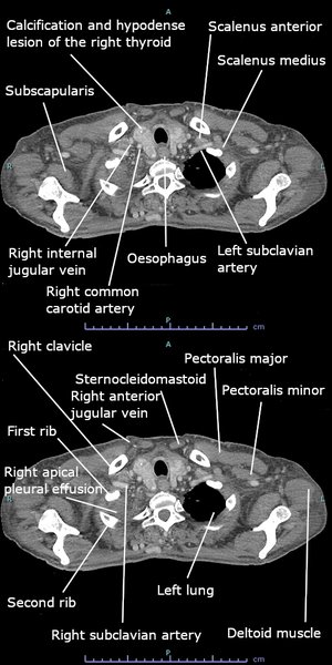 Dissection aortique : physiopathologie et classification