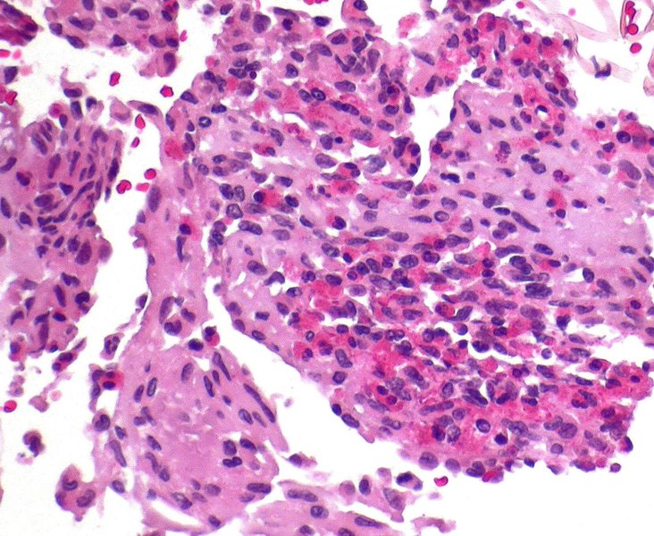 Dissection aortique : physiopathologie et classification