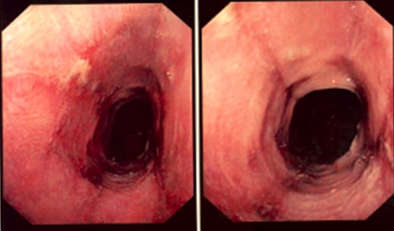 Dissection aortique : physiopathologie et classification