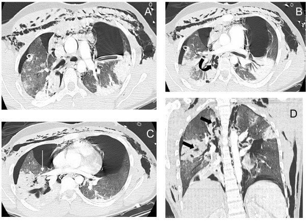 Dissection aortique : physiopathologie et classification