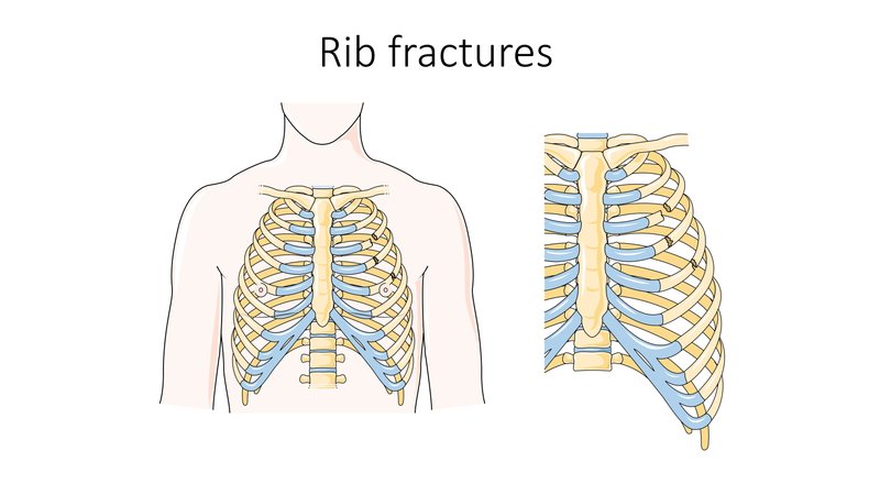 Dissection aortique : physiopathologie et classification