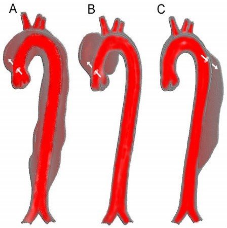 Dissection aortique : diagnostic (TDM, ETO, RP)