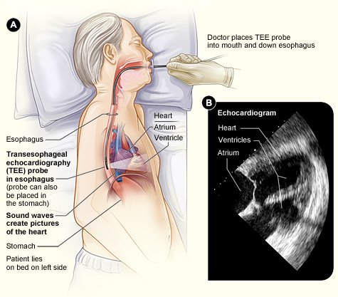 Dissection aortique : traitement