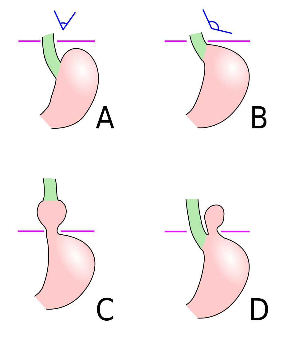 Causes extra-cardiaques de douleur thoracique