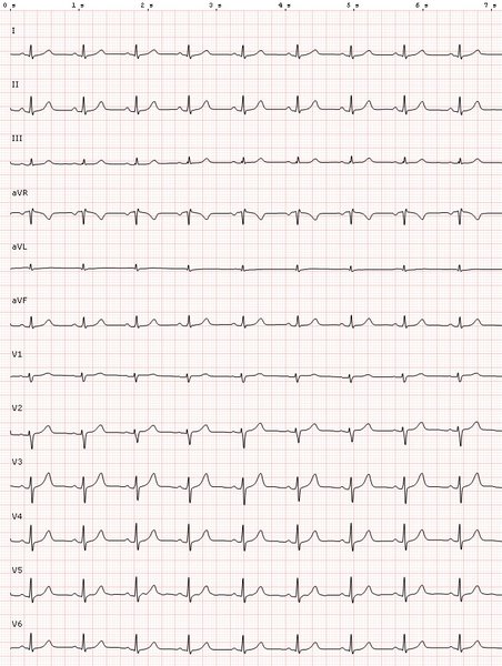 Dérivations ECG et territoires coronaires