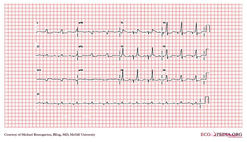 Interprétation ECG : FC, rythme, axe, onde P, PR