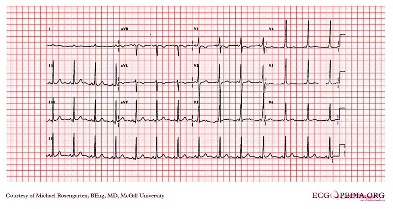 Interprétation ECG : FC, rythme, axe, onde P, PR