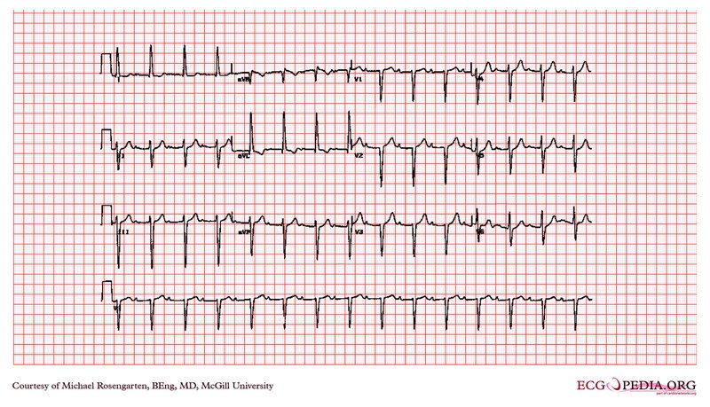 Interprétation ECG : FC, rythme, axe, onde P, PR