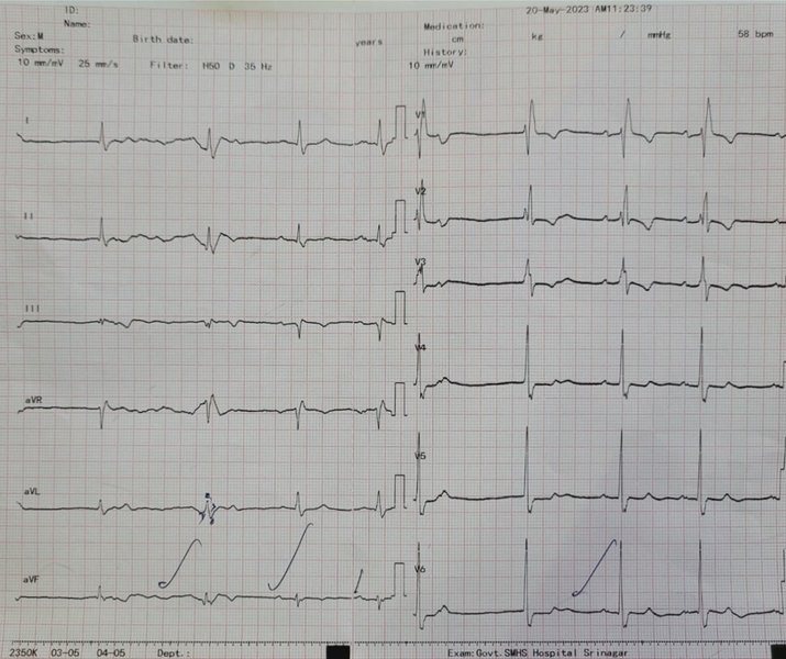 Morphologie QRS normale et pathologique