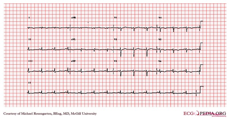 HVG et HVD à l'ECG