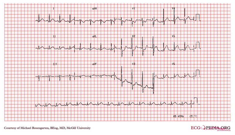 HVG et HVD à l'ECG